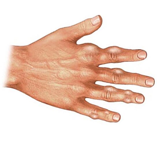 Deposição de cristais de ácido úrico nos tecidos moles dos dedos com artrite gotosa