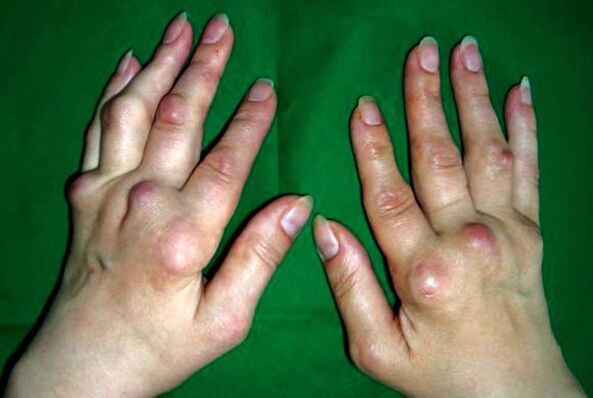 Mãos afetadas por deformantes de poliosteoartrite