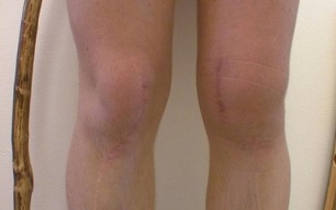 estágios de desenvolvimento da artrose do joelho