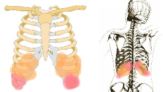 a dor nas costas sob as costelas sintomas
