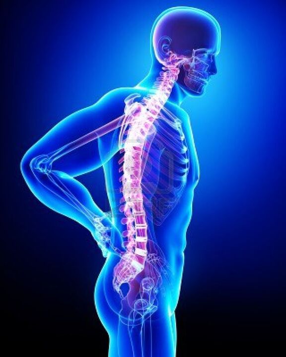 Coluna vertebral humana afetada pela osteocondrose