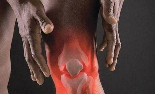 A artrose é acompanhada por um processo inflamatório na articulação do joelho