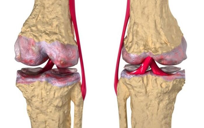 Artrose da articulação do joelho